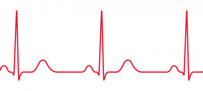 A normal heartbeat ECG